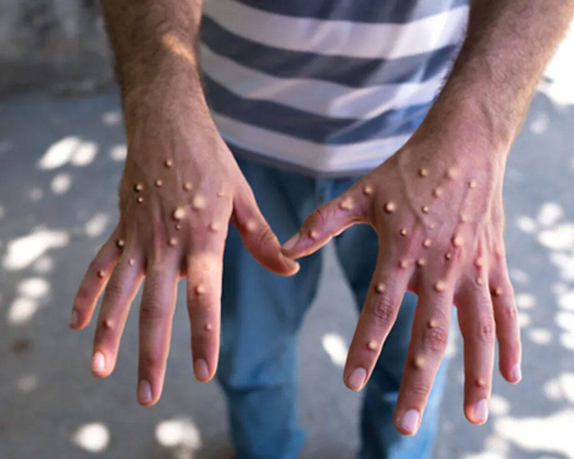 MPOX-in-Pakistan