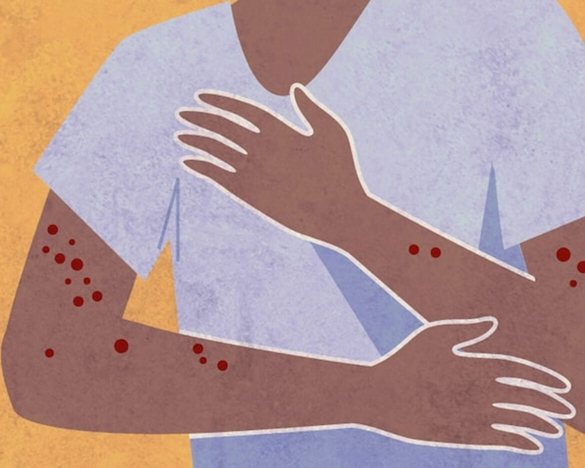 Monkeypox-case